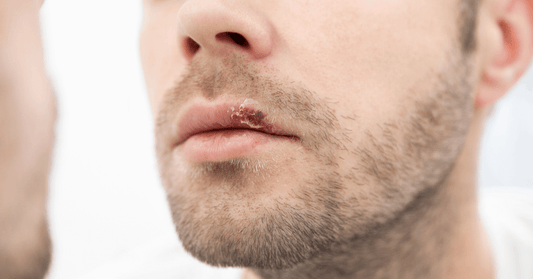 Oral Herpes Treatment