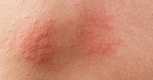 Understanding Shingles: Causes, Prevention, And Treatment
