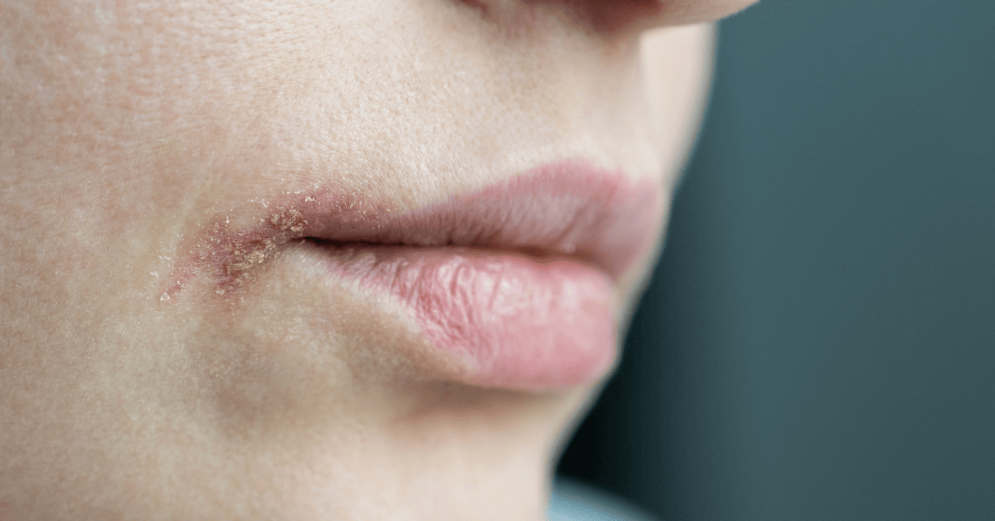 Codol Sore Laser Tech: Cold Sore and Shingles Treatment – Human Healing