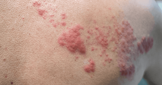 Shingles Treatment