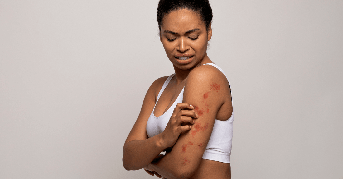 Cream On Rashes Rashes Treatment with Natural Human Healing Cream Solution