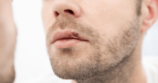 Oral Herpes Treatment